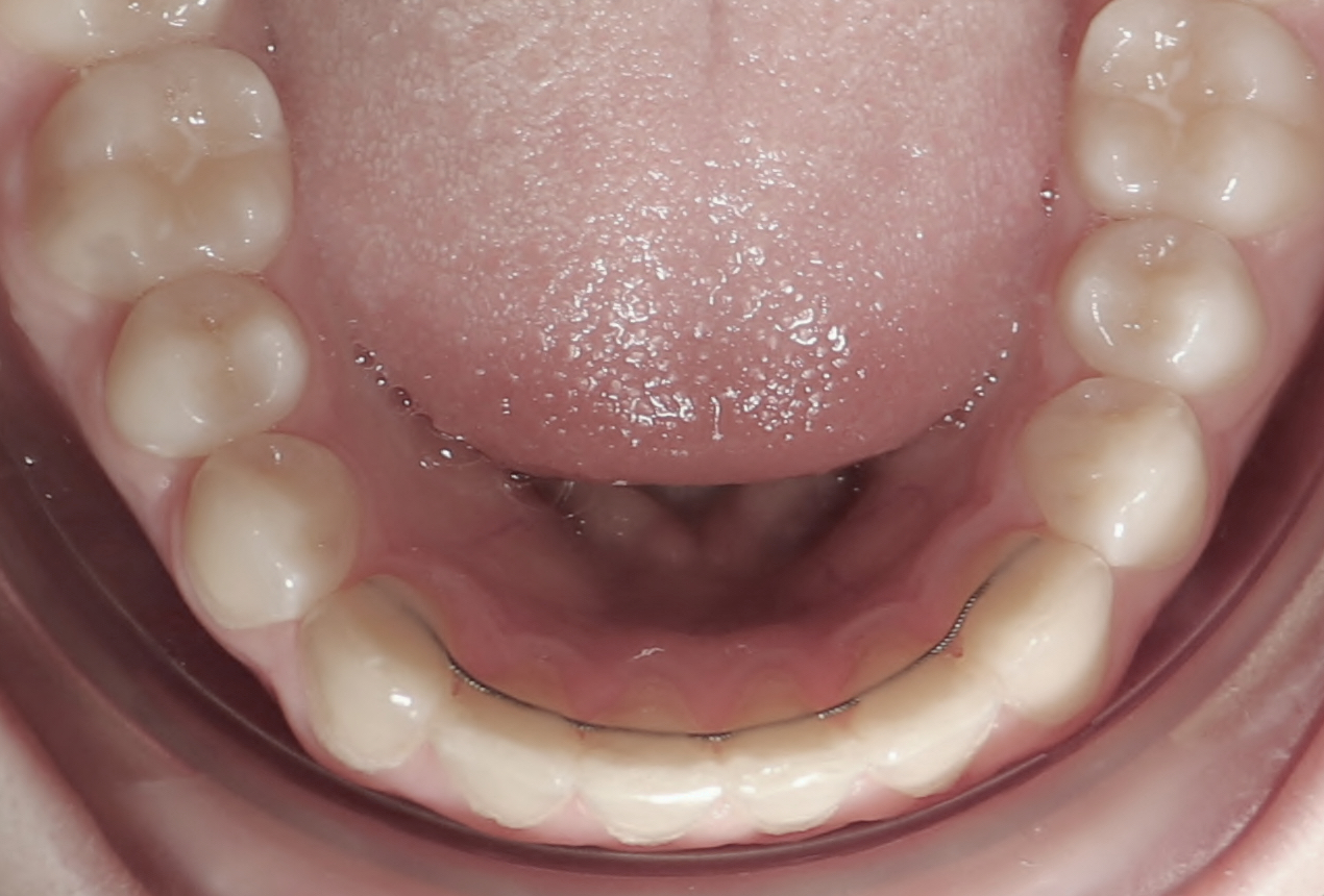 Retainer